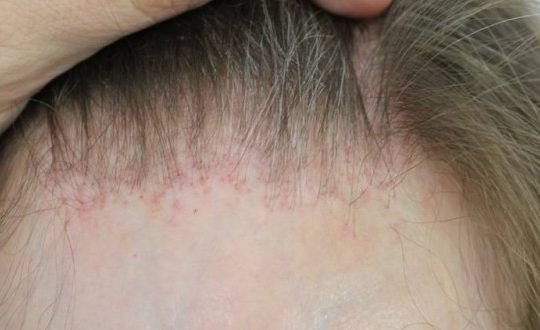 alopecia-frontal-fibrosante