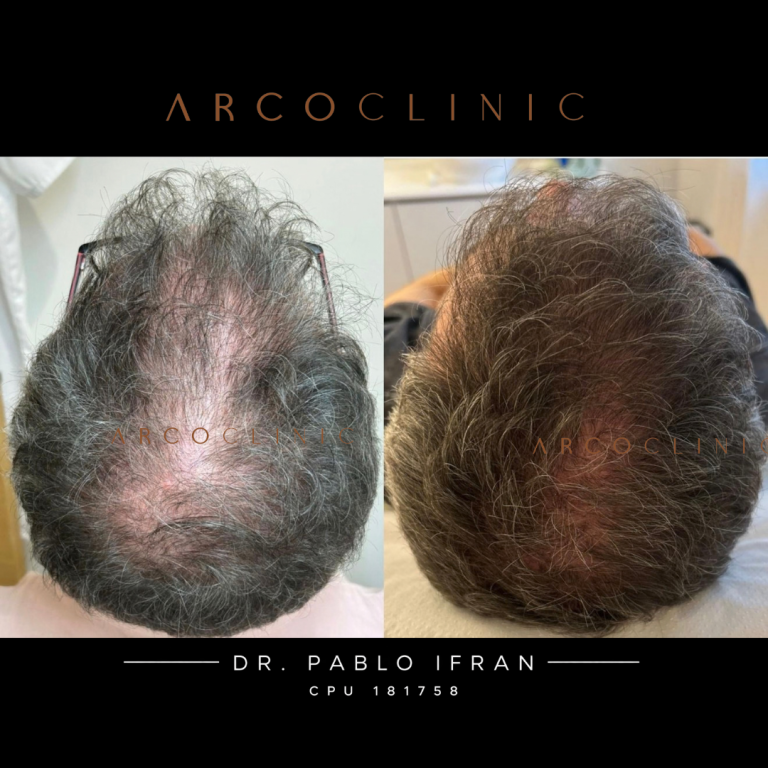Antes y después de seis meses de tratamiento de caída de cabello en un hombre atendido por el Dr. Pablo Ifrán en Uruguay
